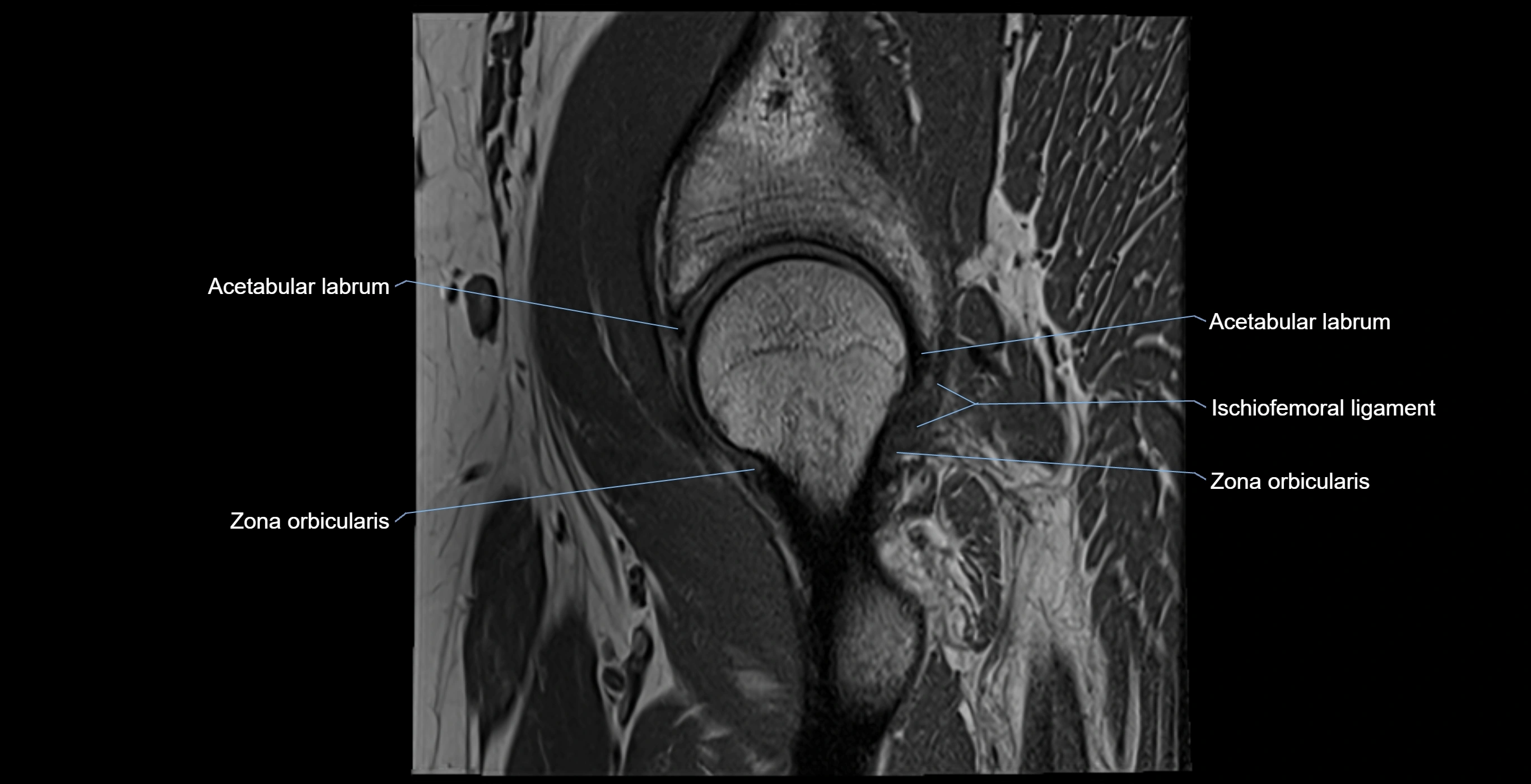 MRI Hip ligaments sagittal cross sectional anatomy 3T  radiology  image-img-00001-00010.webp